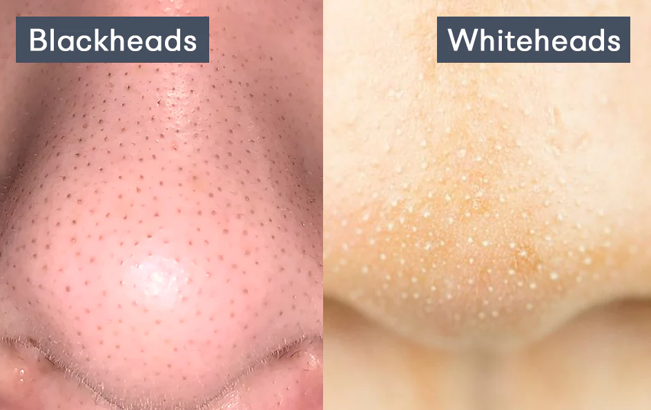 blackheads & whiteheads