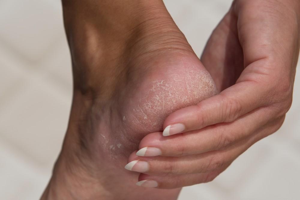 cracked heels